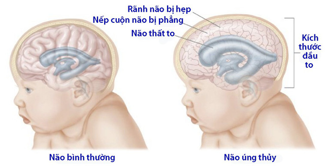 Não úng thuỷ áp lực bình thường - Hình ảnh minh họa